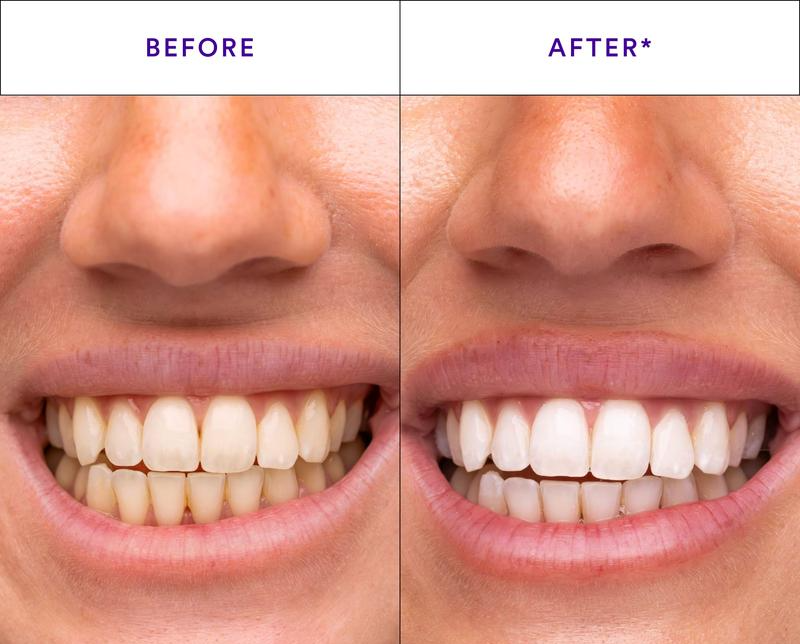 Merraci™ V34 Whitening Strips – Tooth Color Brightening
